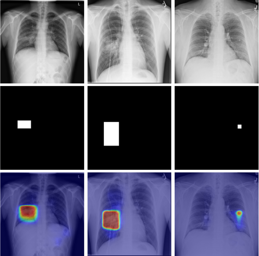 Chest radiographs with ground-truth anomaly masks and predicted anomaly heatmaps